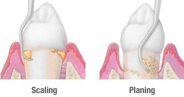 perio-scaling