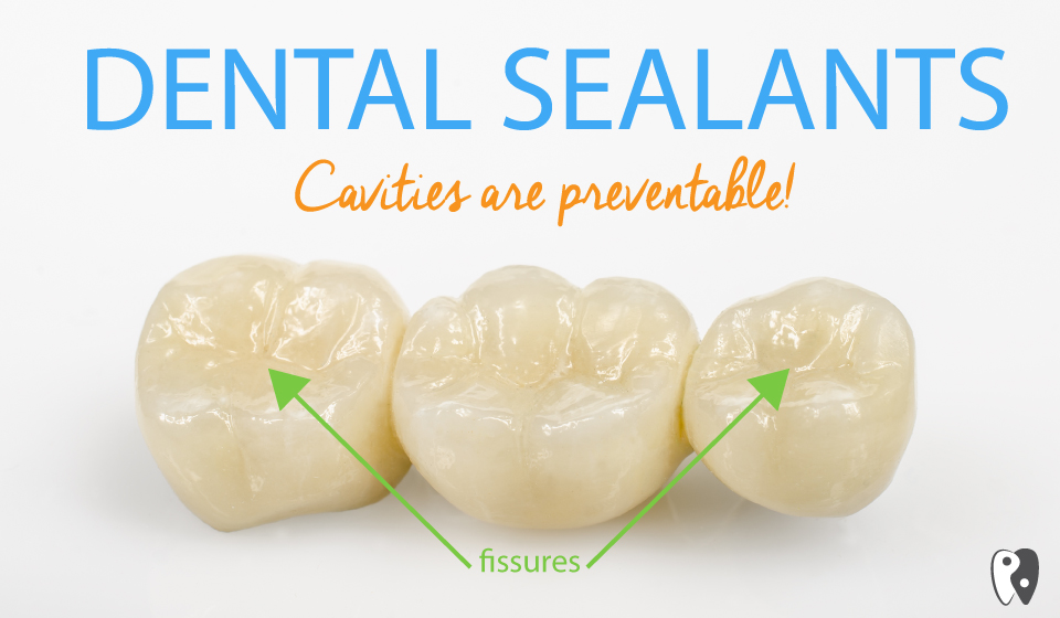 sealants-for-teeth