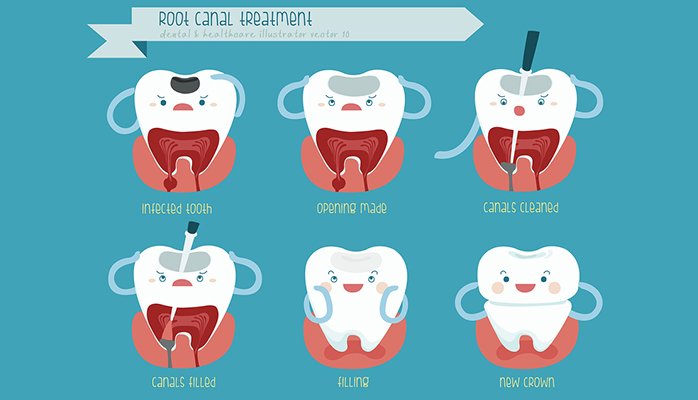 Root canal pain after 3 days