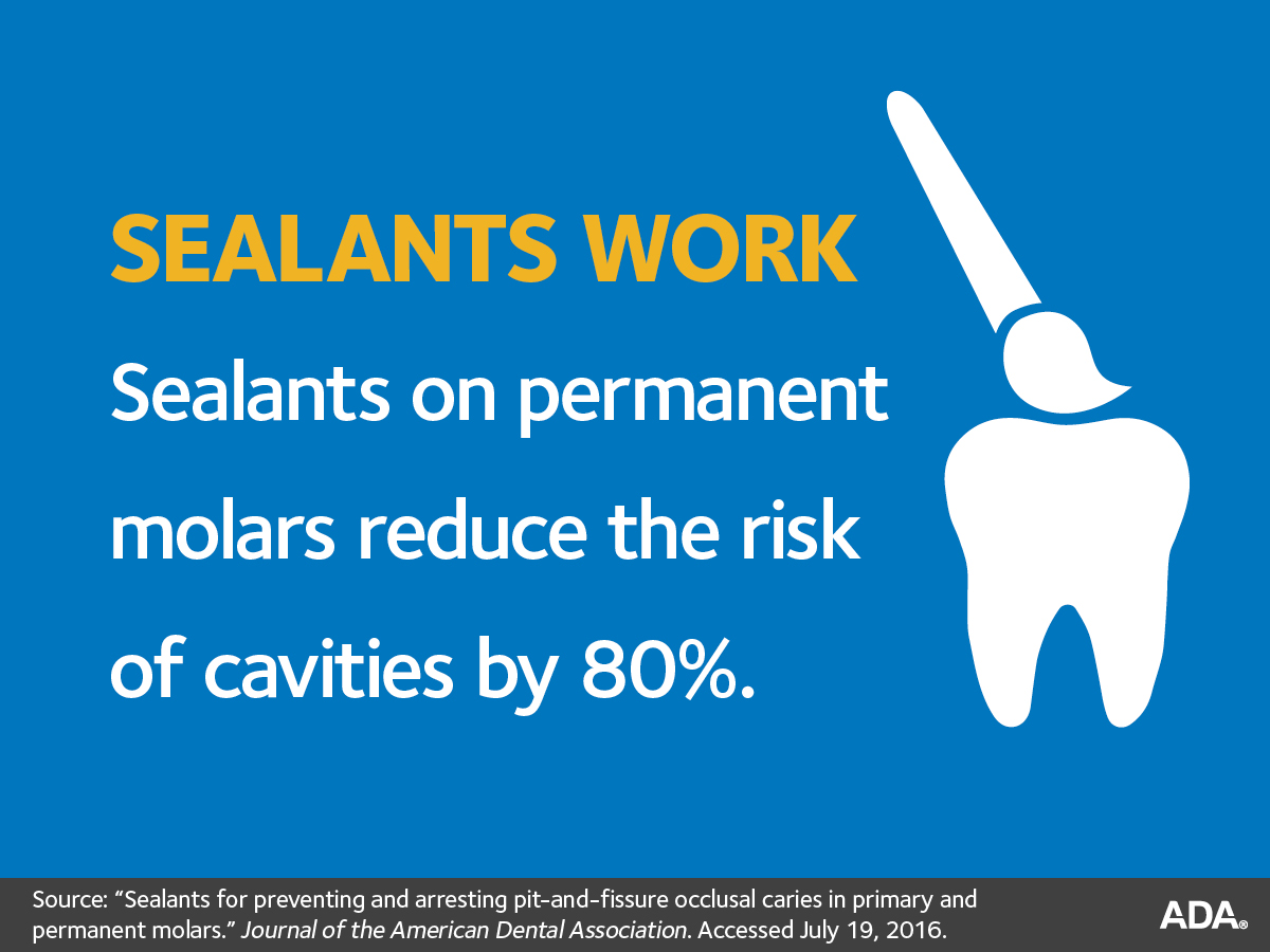 sealants-for-teeth