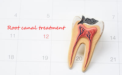 root-canal-treatment