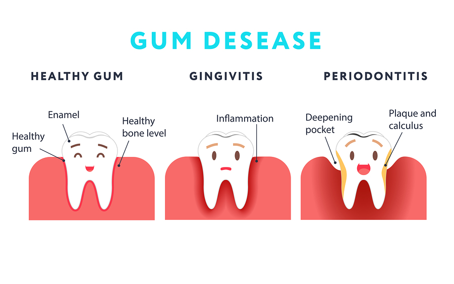 What Are The Symptoms Of Severe Gum Disease