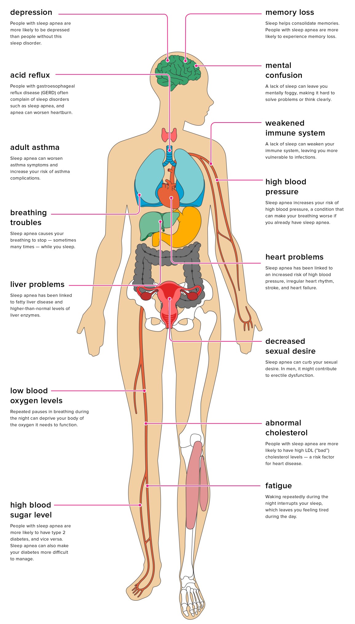 What is Obstructive Sleep Apnea? Causes, Symptoms, Risk Factors