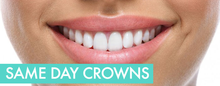 CEREC-same-day-crown