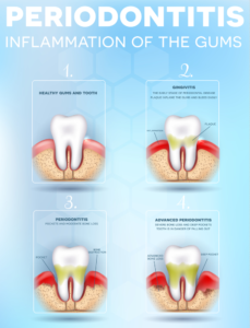 Celebrate National Gum Care Month and Avoid Gum Disease