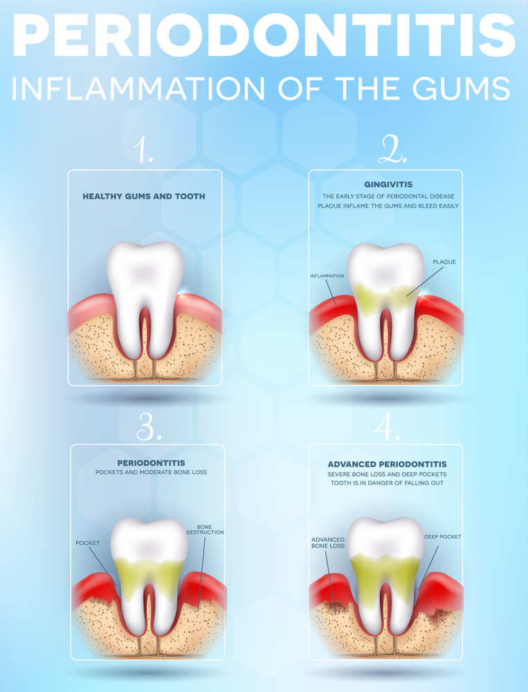 What You Need to Know About Gum Disease