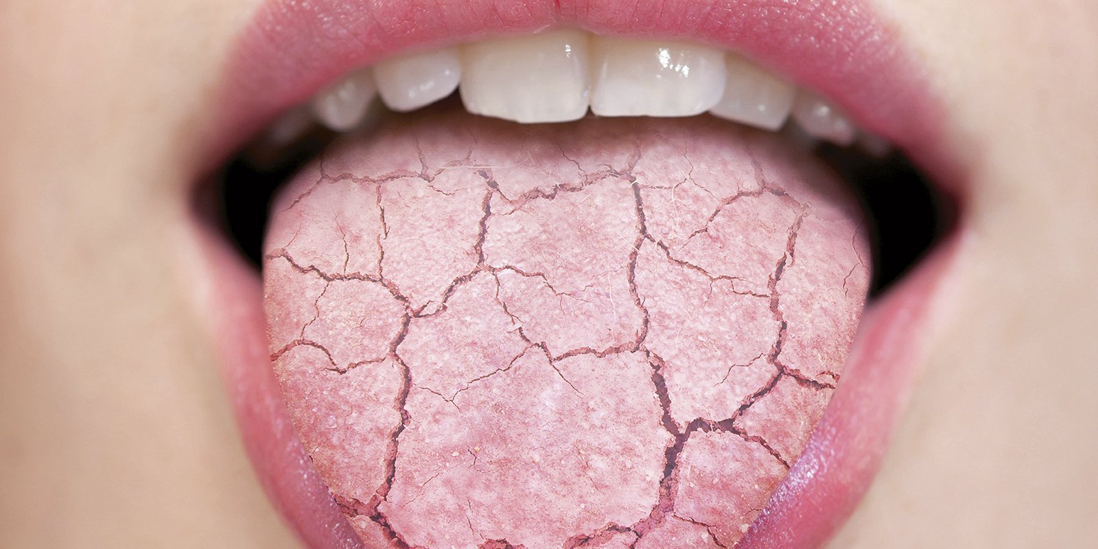 How does Dry Mouth affect your oral and overall body health?