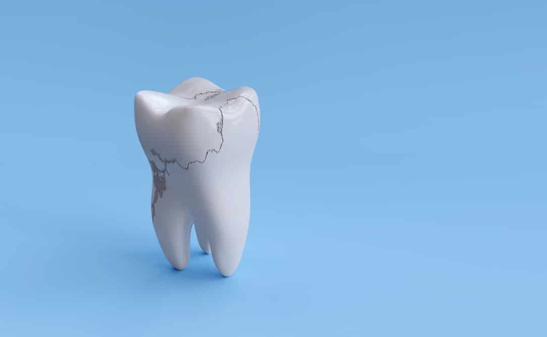 My Tooth Hurts! Do You Have a Broken or Cracked Tooth?