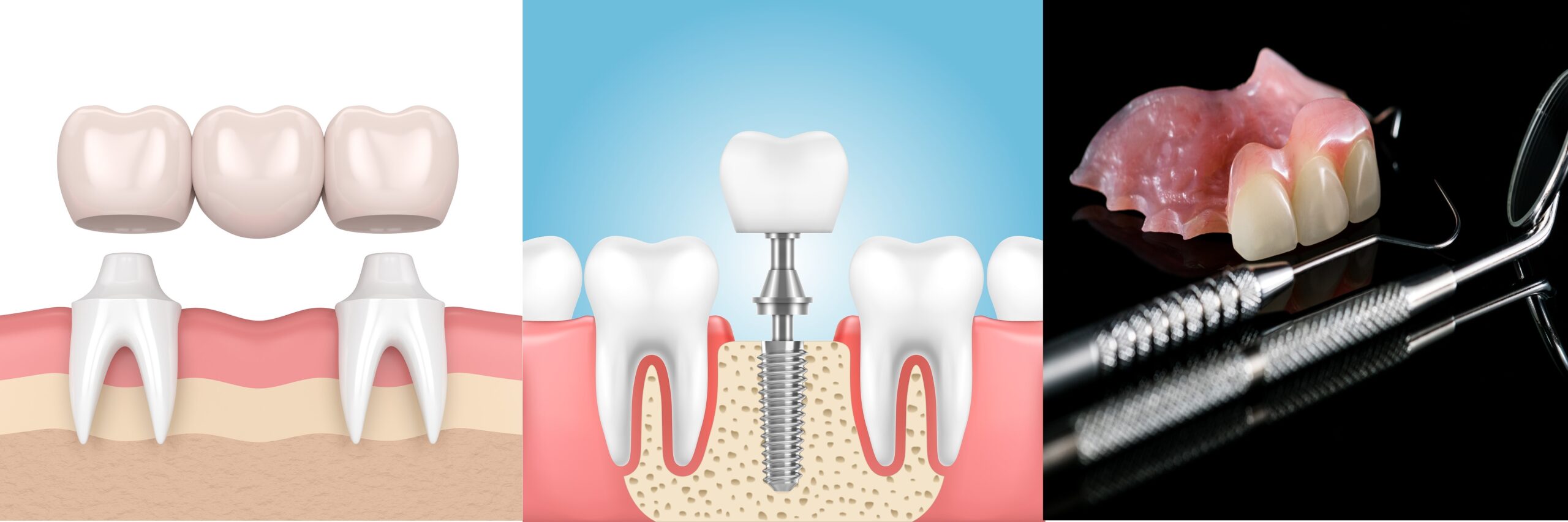 dental-implant-bridge-or-dentures