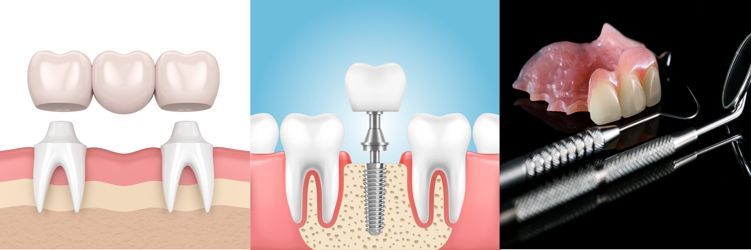 Restore Your Missing Tooth: Dental Implant Bridge or Dentures