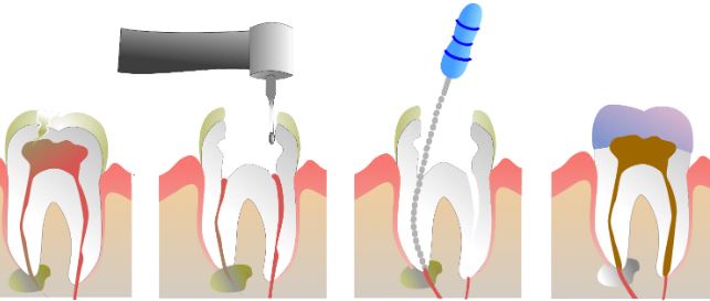 root-canal-procedure