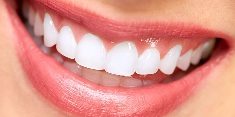 Dental veneers for smile enhancement