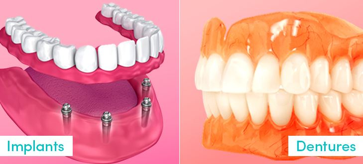 dental-implants-vs.-dentures